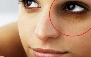 dark-circles-home-treatment