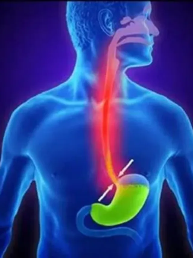 Sedentary lifestyle acid reflux