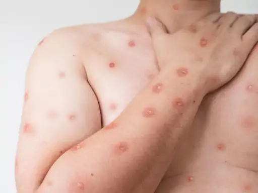 Monkeypox Scare WHO declares global health emergency