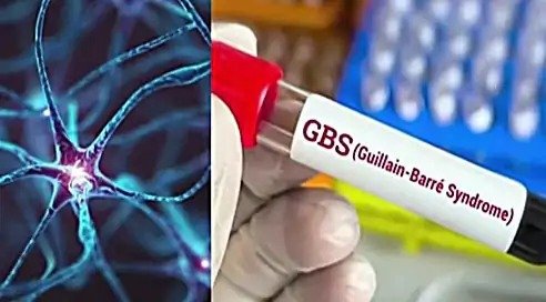 225 cases of GB syndrome in Maharashtra 12 deaths
