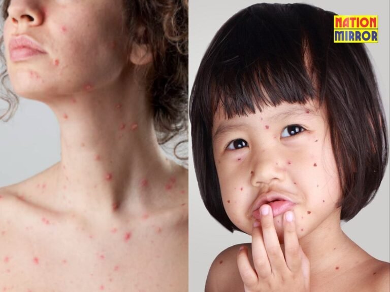 Chickenpox Treatment Myths