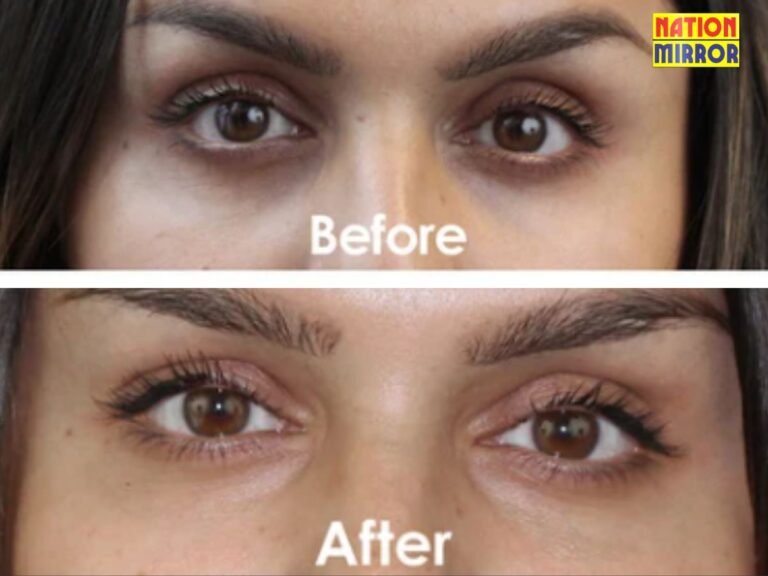 Dark Circle Treatment