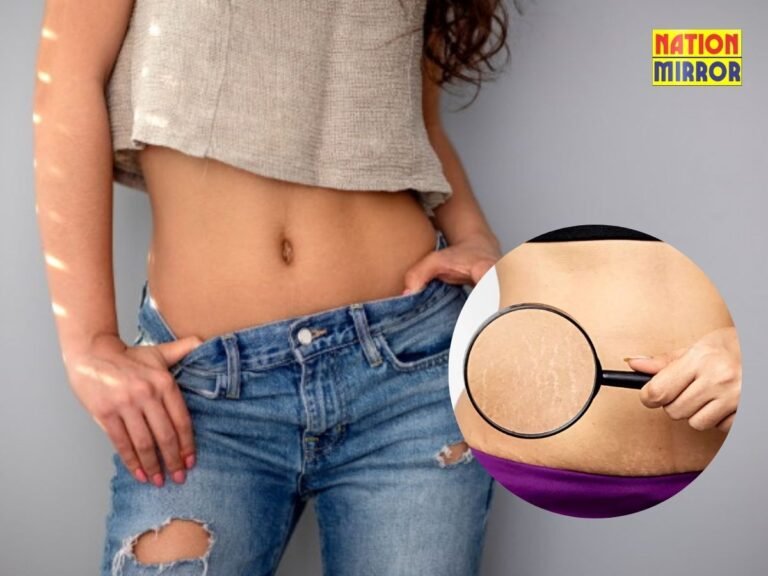 Stretch Marks Removal (1)