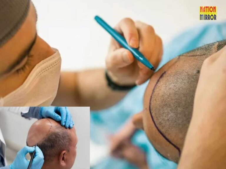 Hair Transplant Risks and Precautions