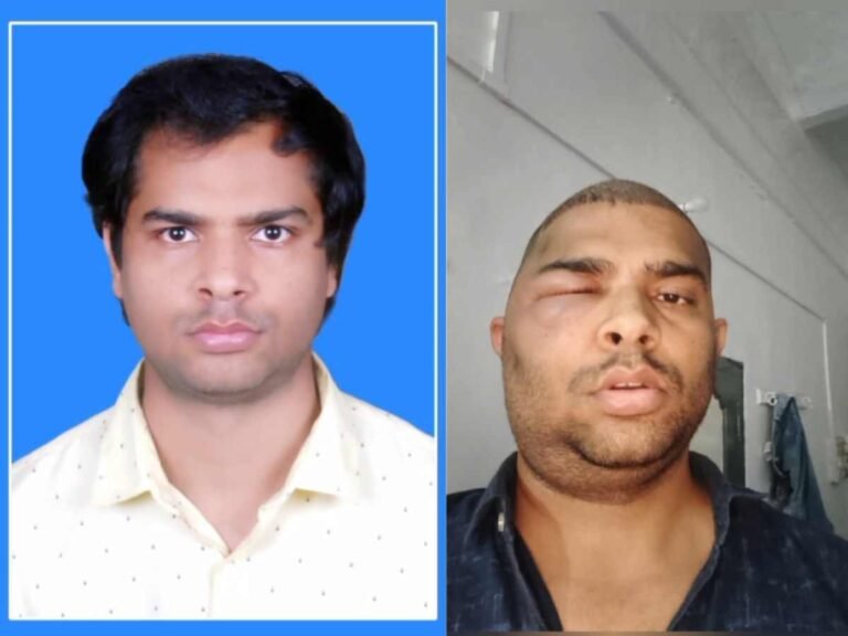 Kanpur Hair Transplant Case: