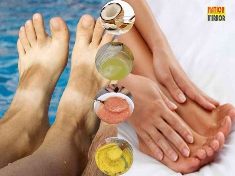Home Remedies for Sandal Tan