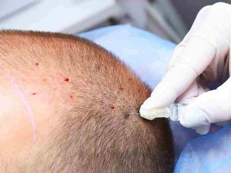 Engineer Dies During Hair Transplant