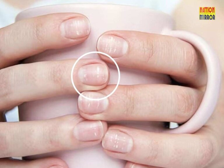 White Spots on Nails