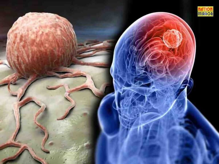 Brain Tumor Symptoms and Treatment