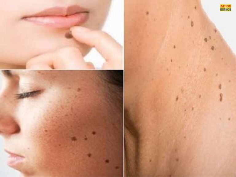 Home Remedies to Remove Moles