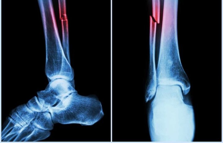 bone healing glue china medical breakthrough