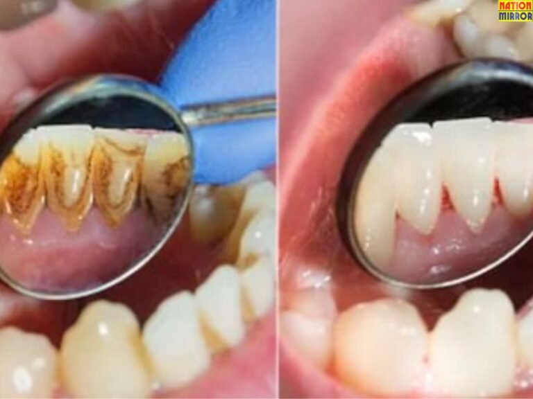 Health Tips दांतो में हैं पायरिया की समस्या के उपाय