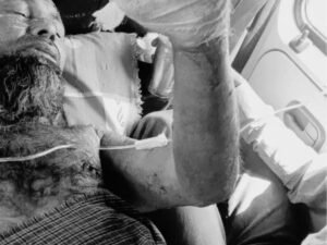 70% जला पीड़ित