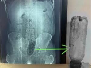 मलद्वार में घुसाई बोतल निकाली