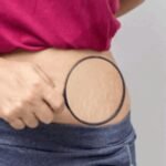 Stretch Marks Removal Tips