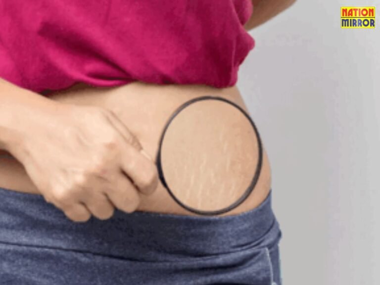 Stretch Marks Removal Tips